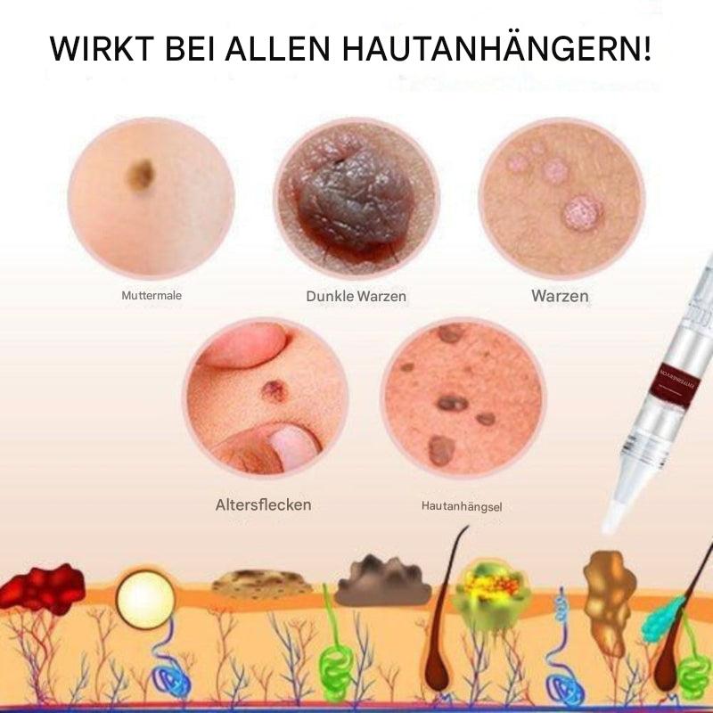 Tags und Muttermalentferner