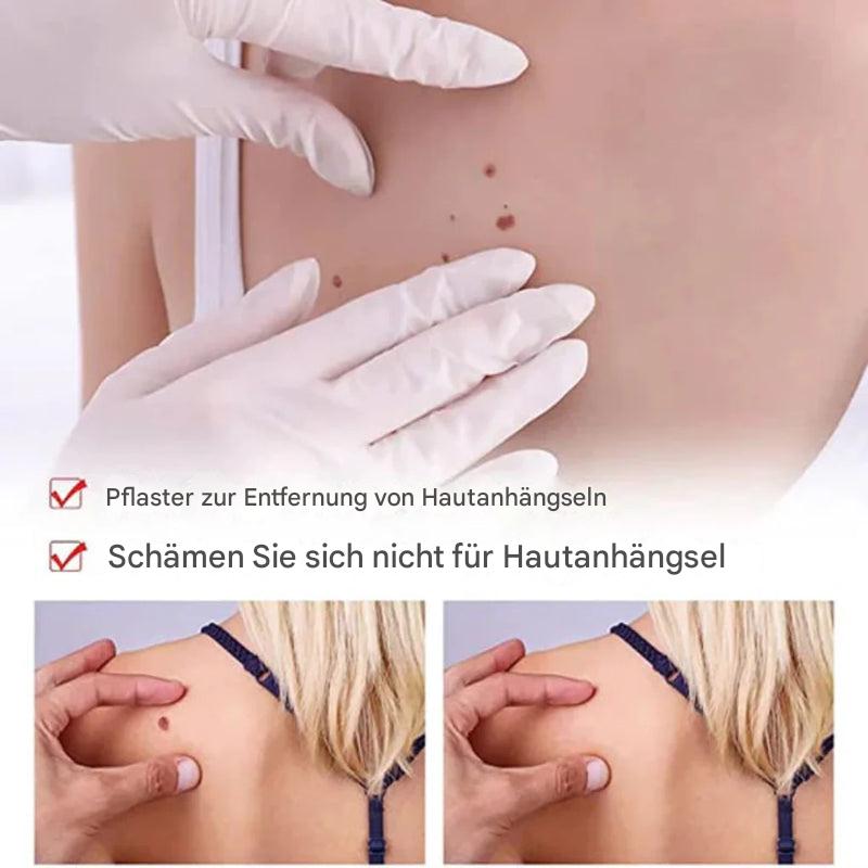 Tags und Muttermalentferner